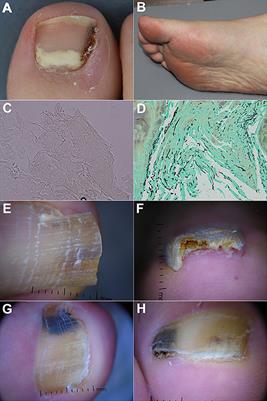 Diagnosis of Onychomycosis: From Conventional Techniques and Dermoscopy to Artificial Intelligence